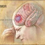 a medical illustration of a brain tumor