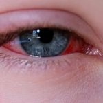 Mayo Clinic Q & A: Seeing clearly: Understanding pink eye