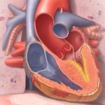 medical illustration of heart with hypertrophic cardiomyopathy